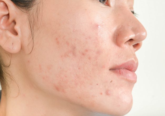 Perbedaan Fungal Acne Dan Bruntusan, & Milia Yang Kamu Harus Tau!